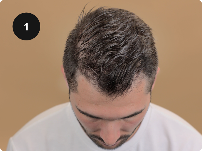 El problema de la caída del cabello