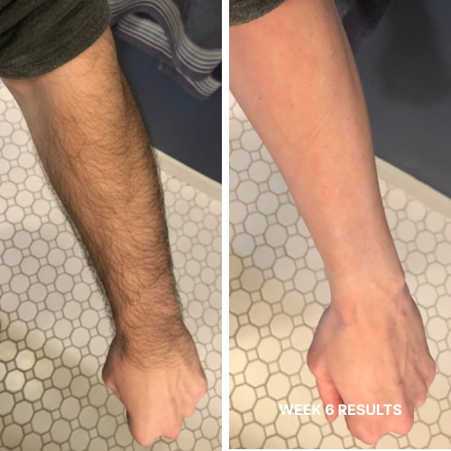 Complete Hair Removal System Bundle ($199.96 Value)