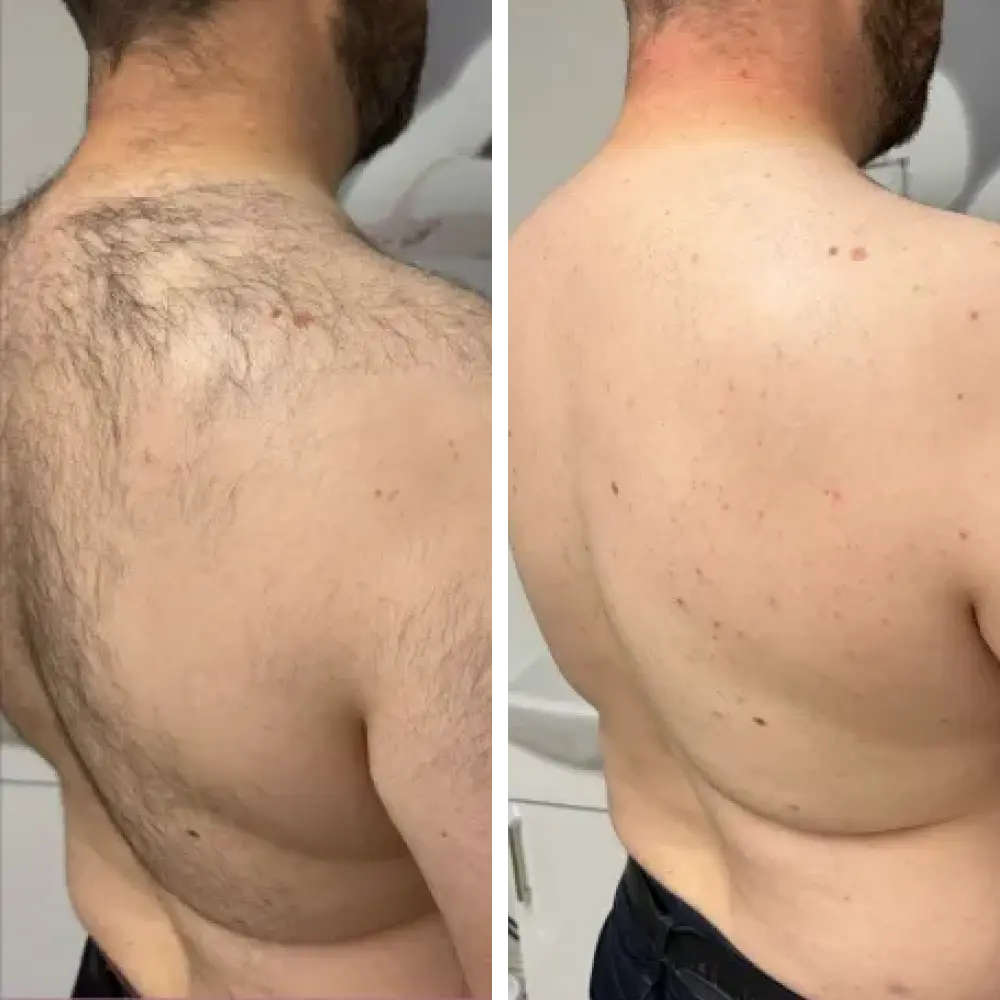 Complete Hair Removal System Bundle ($199.96 Value)