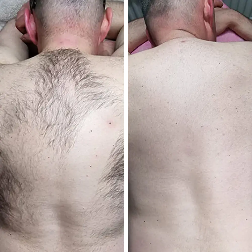 Complete Hair Removal System Bundle ($199.96 Value)