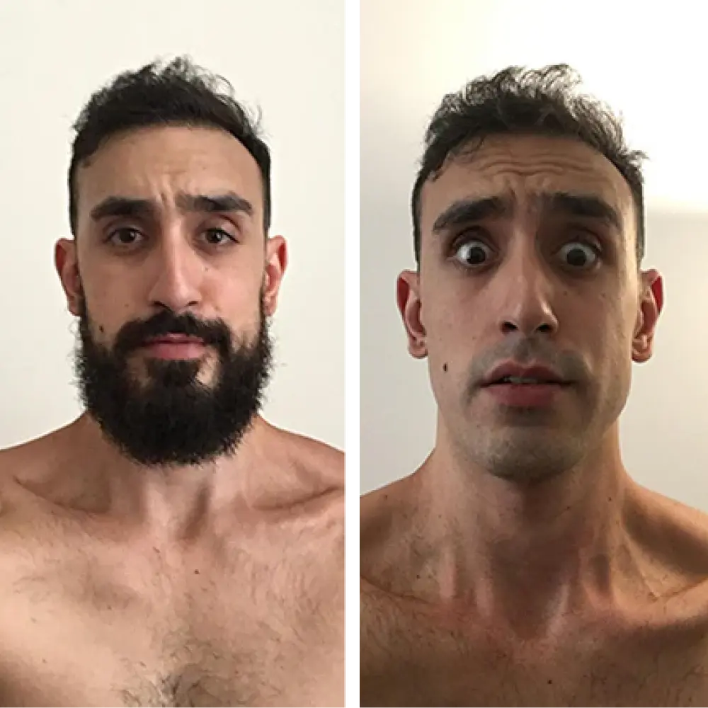 Complete Hair Removal System Bundle ($199.96 Value)