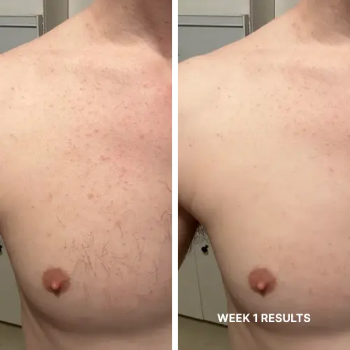 Complete Hair Removal System Bundle ($199.96 Value)
