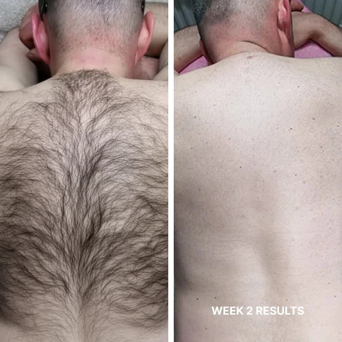 Complete Hair Removal System Bundle ($199.96 Value)