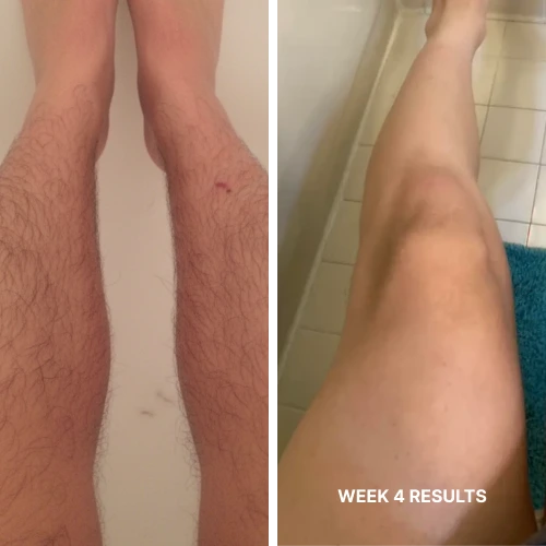 Complete Hair Removal System Bundle ($199.96 Value)