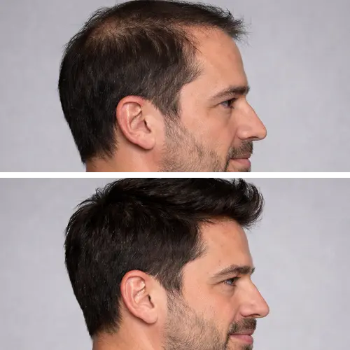 Before and After Results