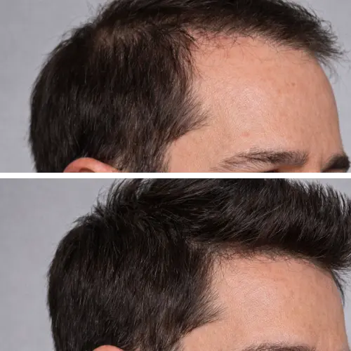 Before and After Results
